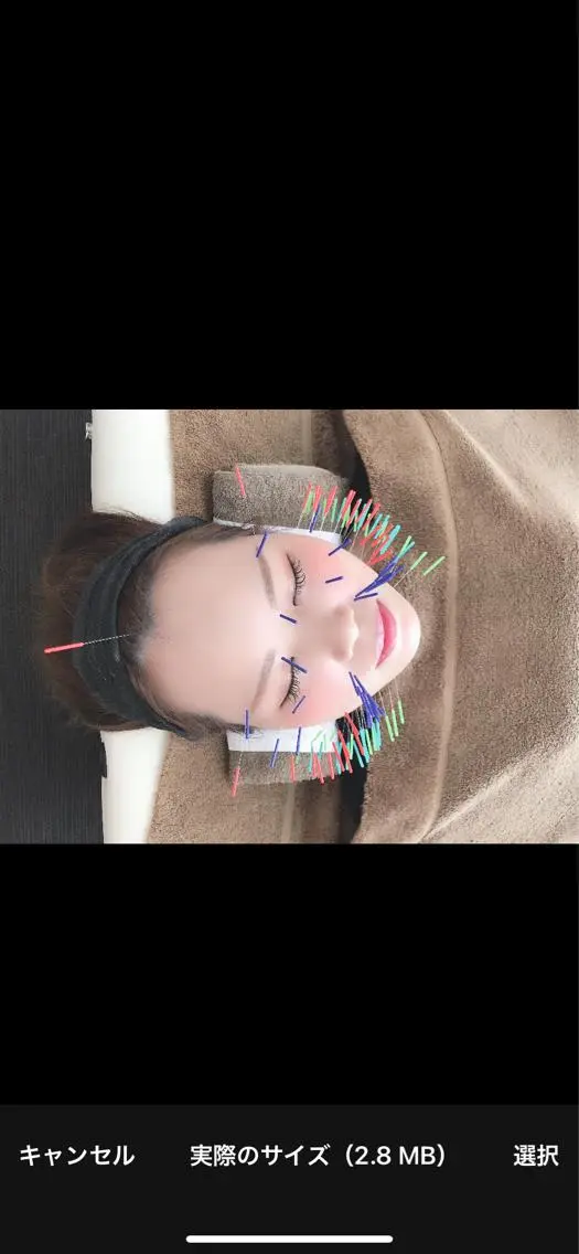美容鍼の写真