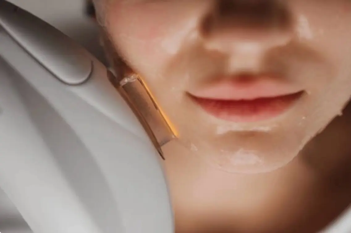 【トーンアップ&美白効果も♡】顔脱毛（美容パック付き）の写真