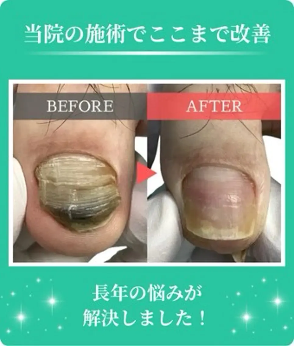 【初めての方】足の変形爪・深爪・肥厚爪ケア1指🦶の写真