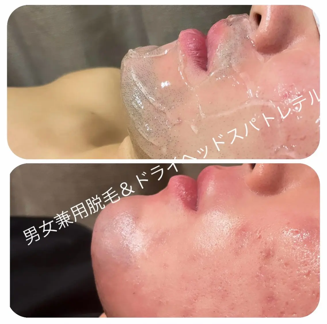 メンズひげ脱毛/画像は8回目の結果です。の写真
