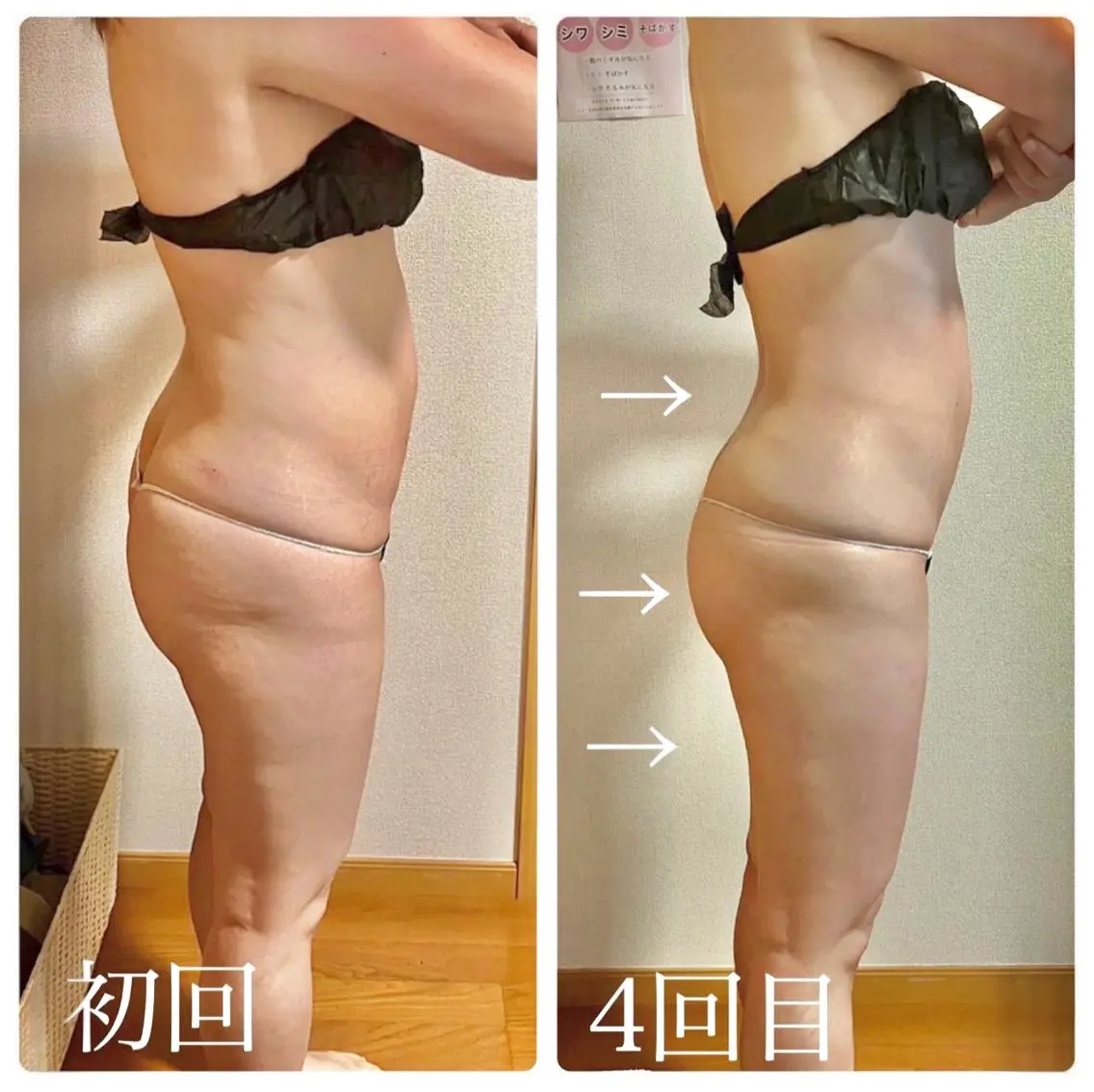 【全身痩身🌻】キャビ×RF×バキュームでスッキリボディーに🔥の写真