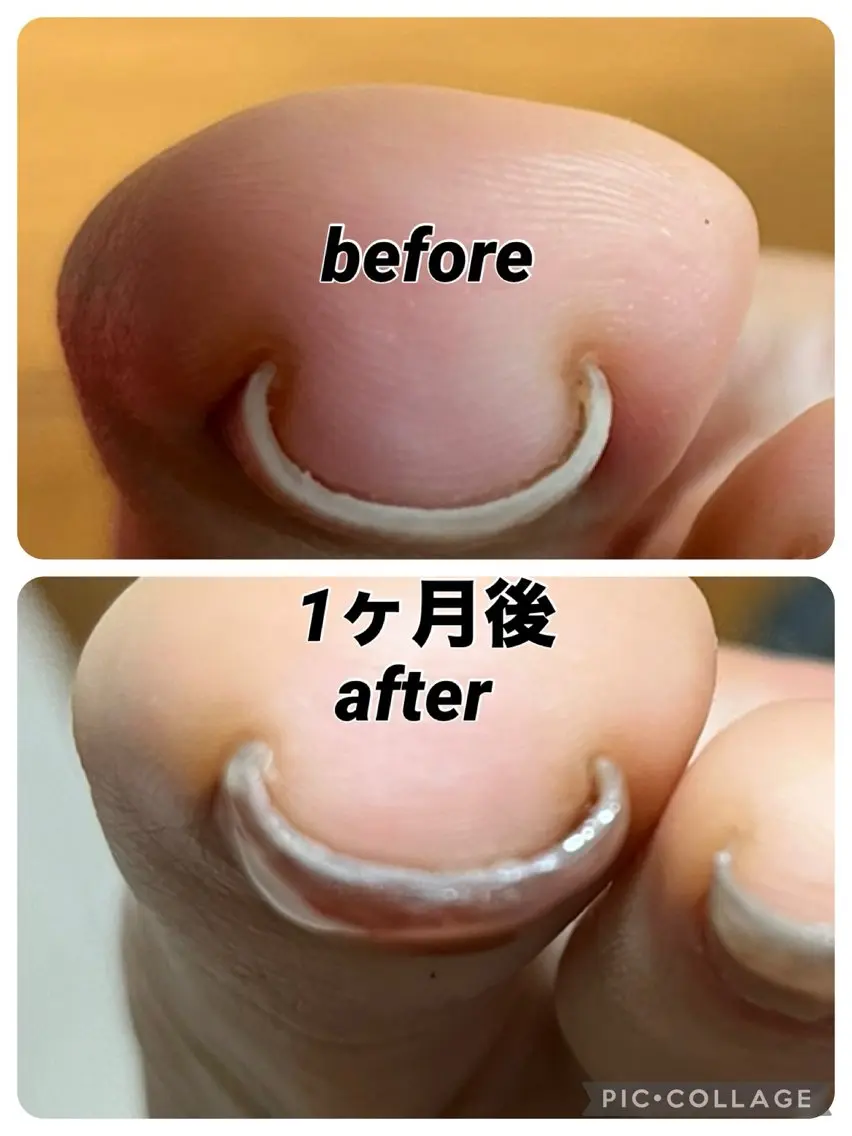 巻き爪ジェル一本の写真
