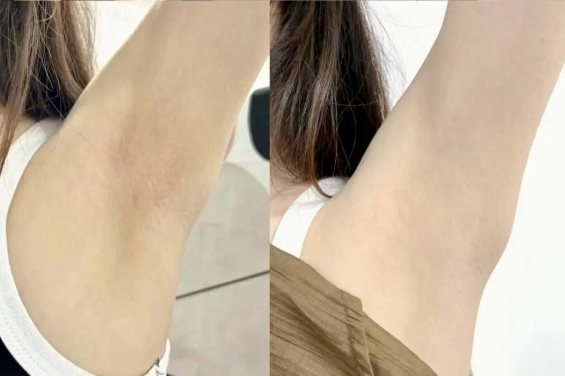 【脇の黒ずみ★即効撃退】Keilance乳酸ピーリング美白ケア 4980円の写真