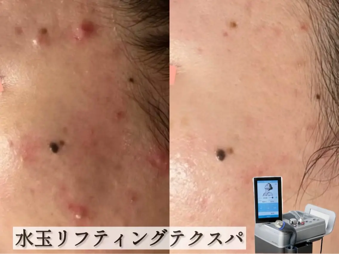 【ニキビ跡、敏感肌】水玉リフティングテクスパの写真