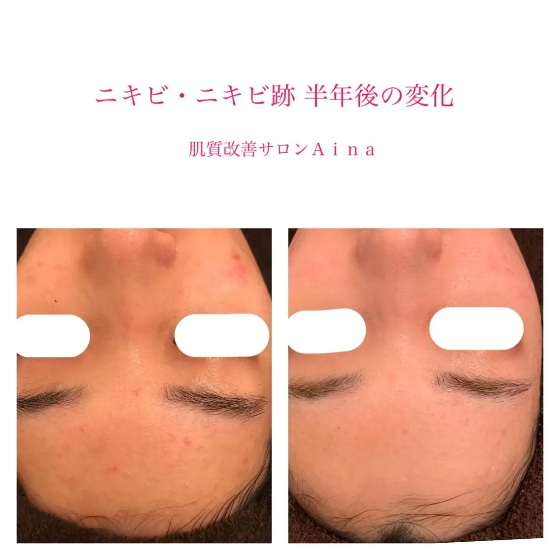 ロング カラー パーマ キッズ ネイル マツエク・マツパ 卒業式のヘアスタイル 学生 卒業式 赤色 エステ リラク ニキビ跡専門サロン Ainaのエステ・リラクイメージ