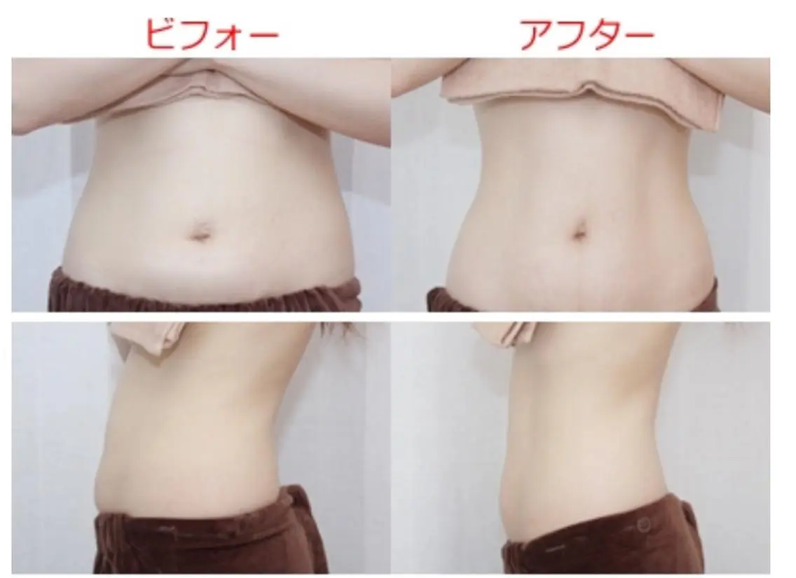 【ご新規様限定】✨全身デトックス✨ハイパーナイフ&オールハンドリンパドレナージュ！ハイパーナイフスリム！贅沢に160分！の写真