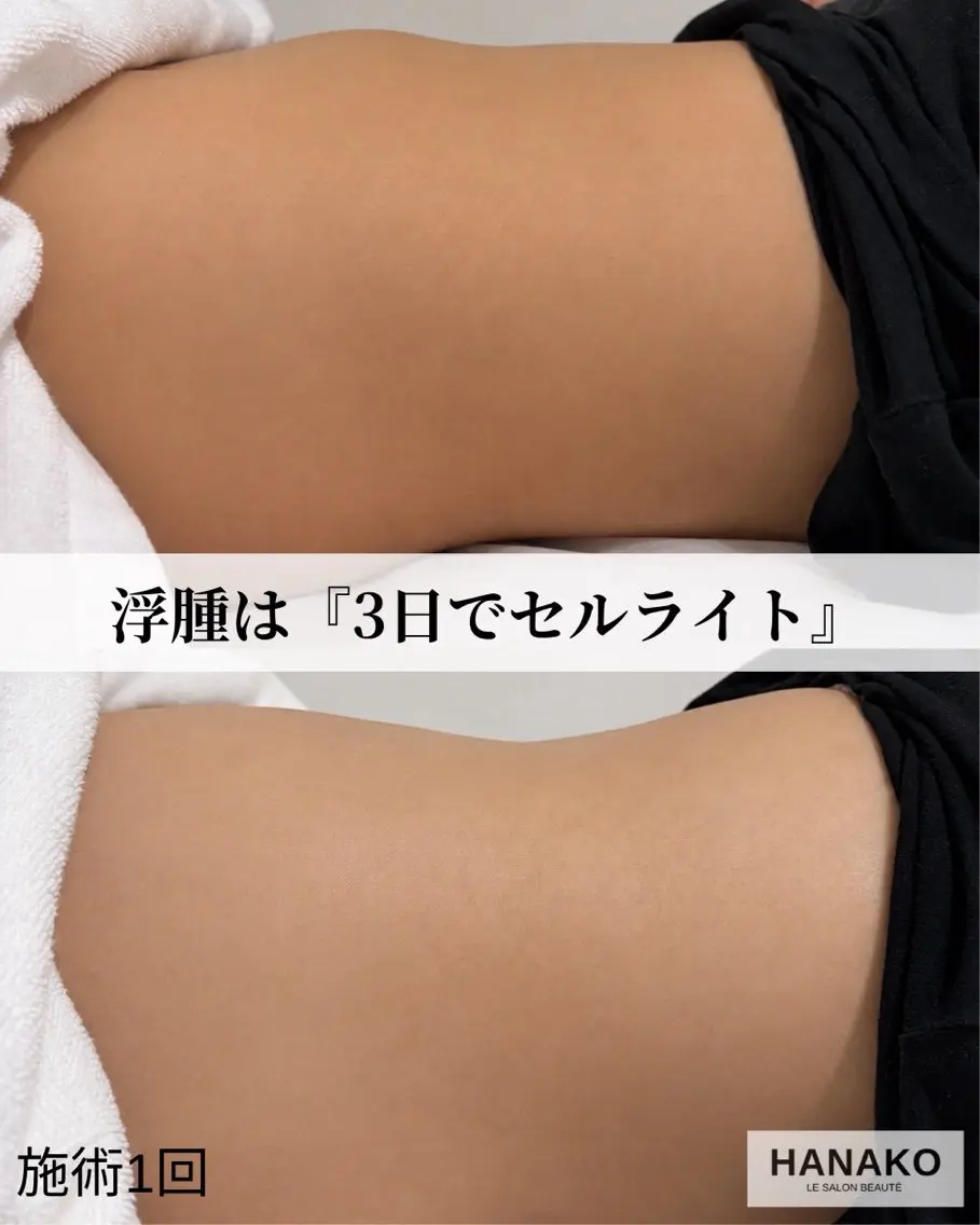 華奢見えスリム【痩身×腸もみ】ハンド＋セルライト分解キャビテーション60分の写真
