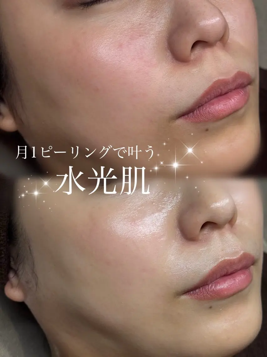 ミニモ限定価格【ニキビ/ザラつきにはこれ】ハーブピーリング、オイルデコルテ/肩/首マッサージ付き♪の写真