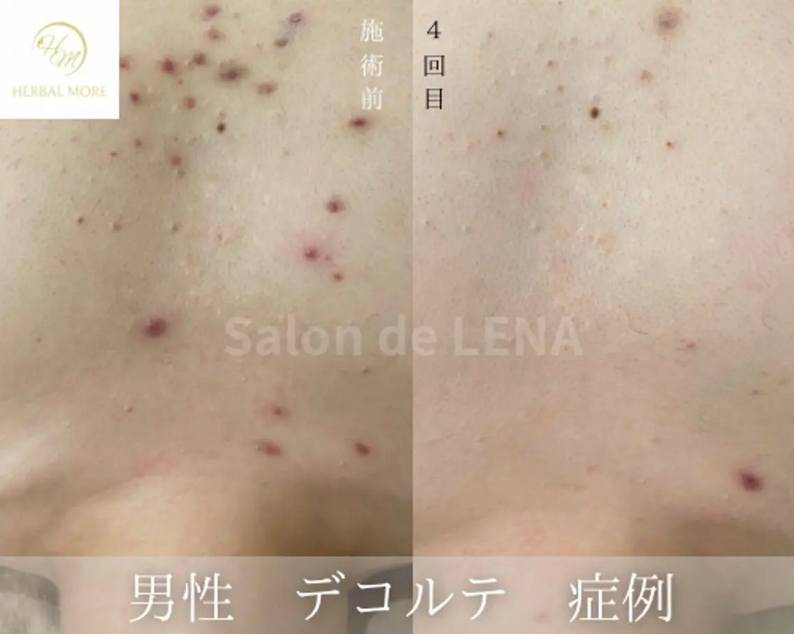【デコルテハーブピーリング/剥離有・無】ニキビケア、色素〇着、毛穴、サメ肌の写真