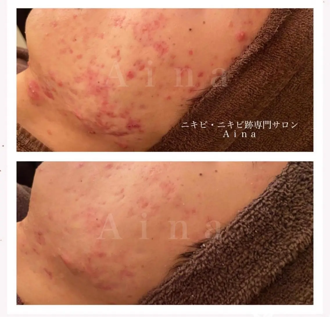 ショート カラー パーマ ヘアアレンジ メンズ キッズ ネイル マツエク・マツパ アイブロウ ブルーカラー ブルー 赤色 エステ リラク ニキビ跡専門サロン Ainaのエステ・リラクイメージ