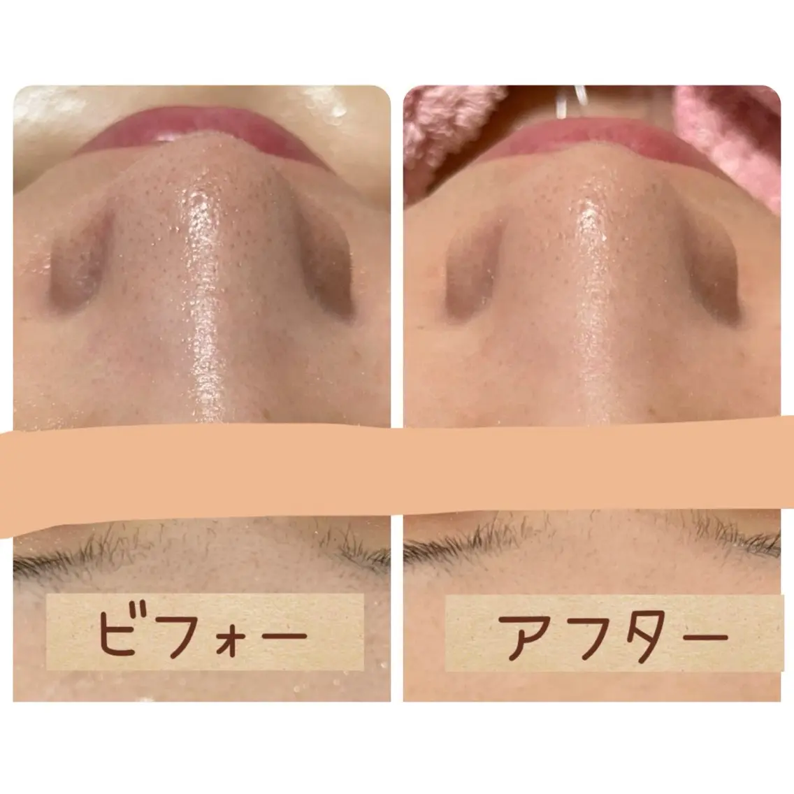 エステ 毛穴洗浄×リンパケア 🫧つるんと素肌へのエステ・リラクイメージ