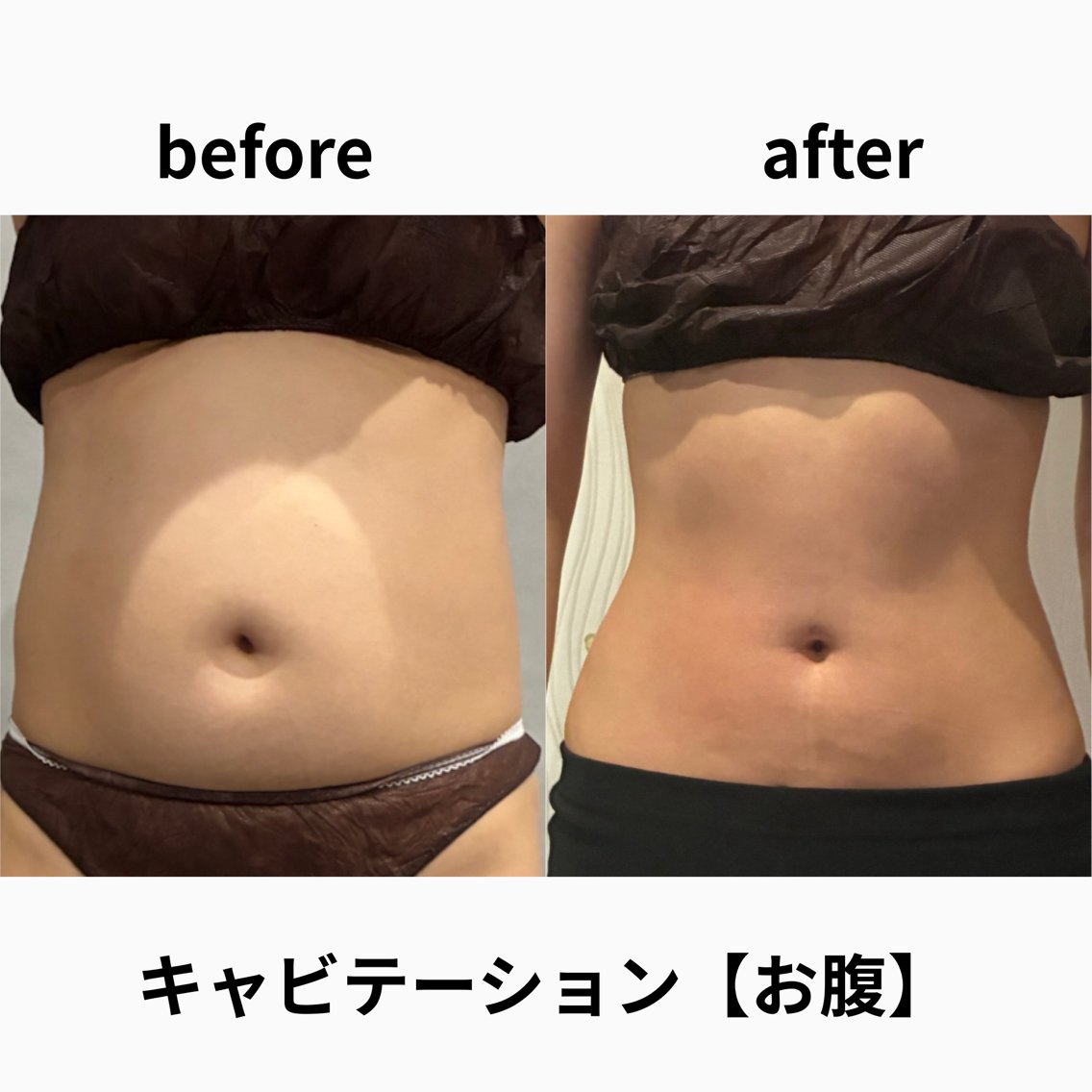【気になる1部位集中】ｷｬﾋﾞﾃｰｼｮﾝ×温め×EMS 30分の写真
