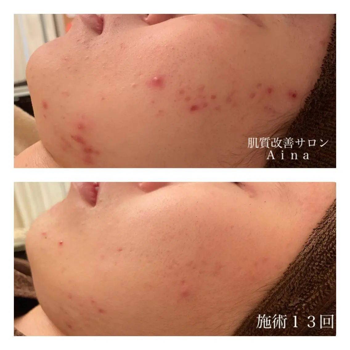 ミディアム カラー パーマ ヘアアレンジ メンズ キッズ ネイル マツエク・マツパ ニキビ跡専門サロン Ainaのエステ・リラクイメージ