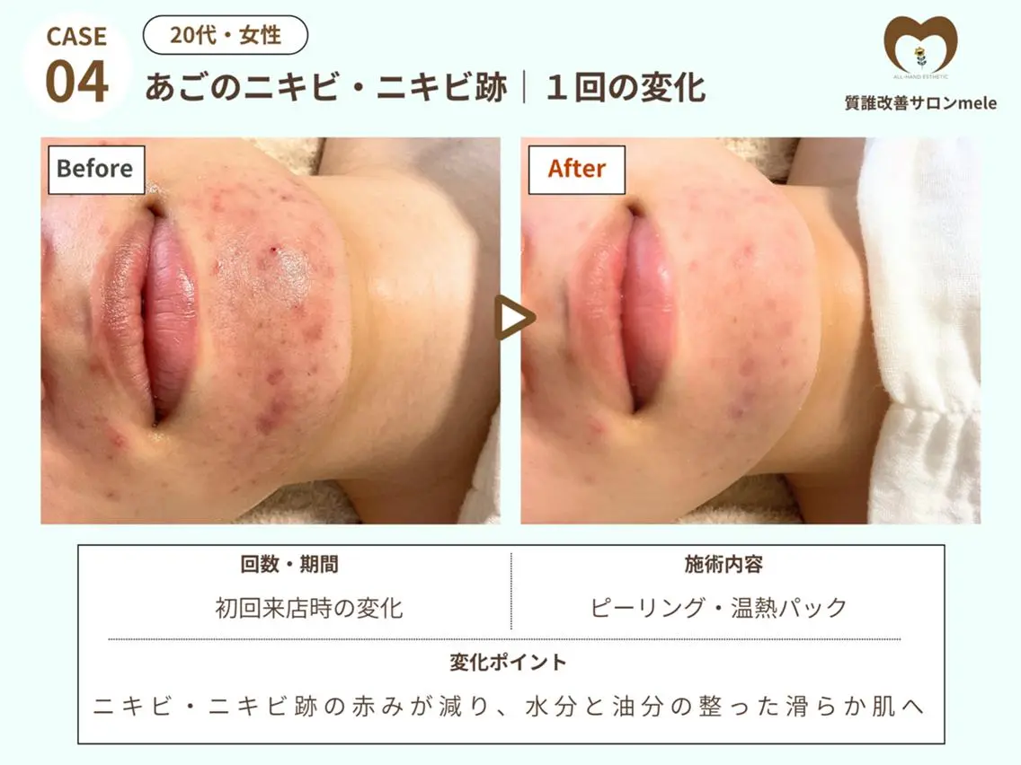🌈人気No.1🌈繰り返す大人ニキビを本気でケア◎角質除去+温熱パック¥17,500→¥8,800の写真