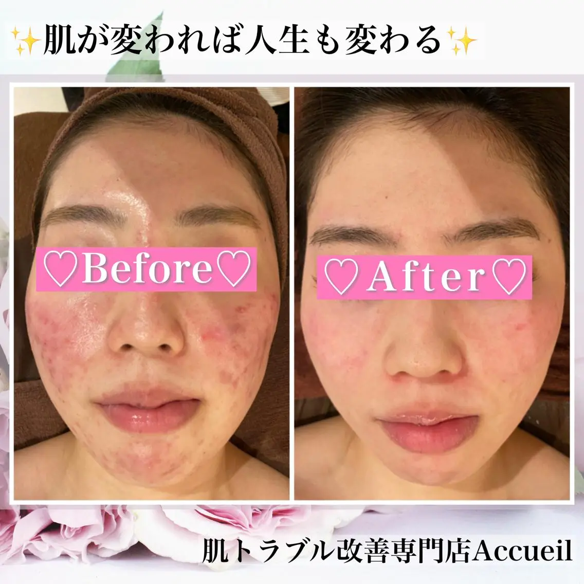 ミディアム カラー パーマ ヘアアレンジ メンズ キッズ ネイル マツエク・マツパ アイブロウ エステ リラク ニキビ・肌質改善専門 ♡人生が変わるサロンのエステ・リラクイメージ