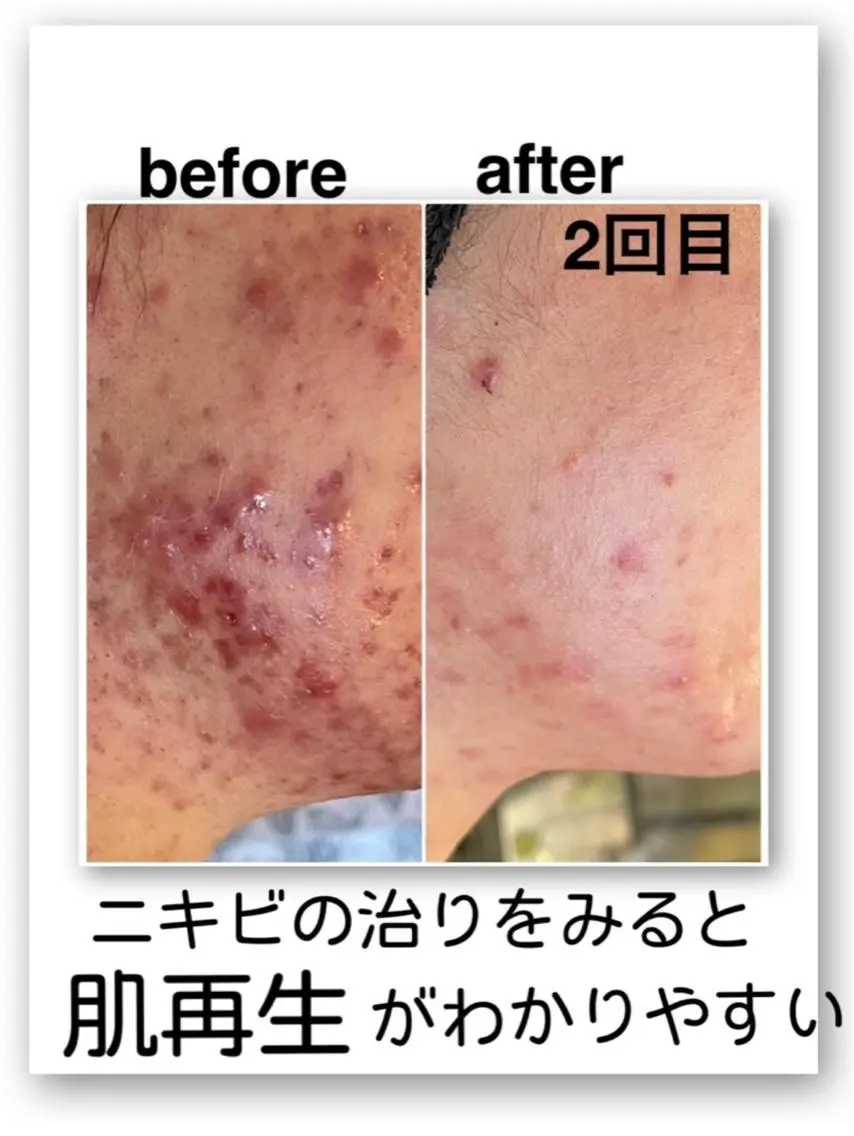 とにかく早い！ニキビやニキビ跡に効果絶大♪肌を生まれ変わらせるプログラム！（BELLA CELLA）韓国発!の写真