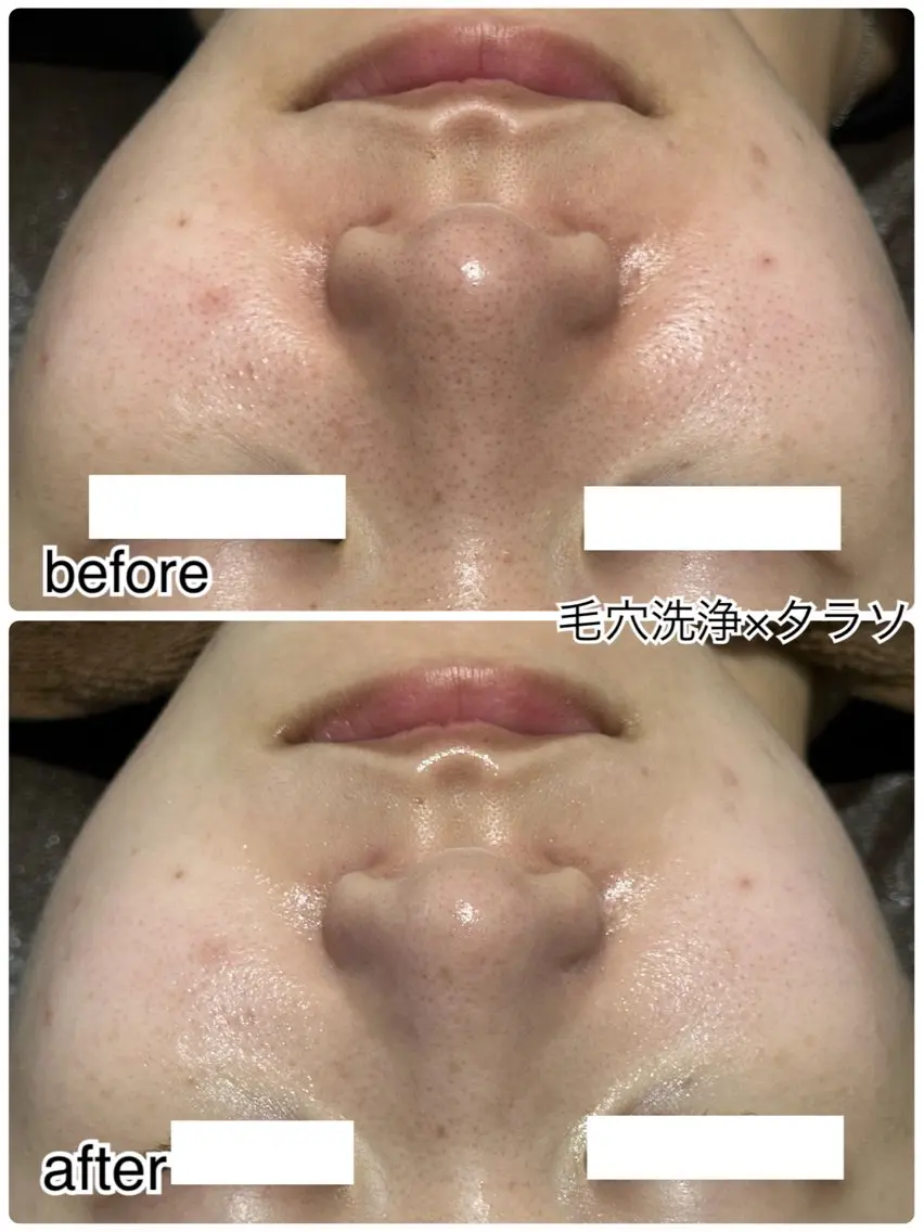 【黒ずみ開き毛穴・くすみケアNo.1👑】タラソトリートメント🫧の写真