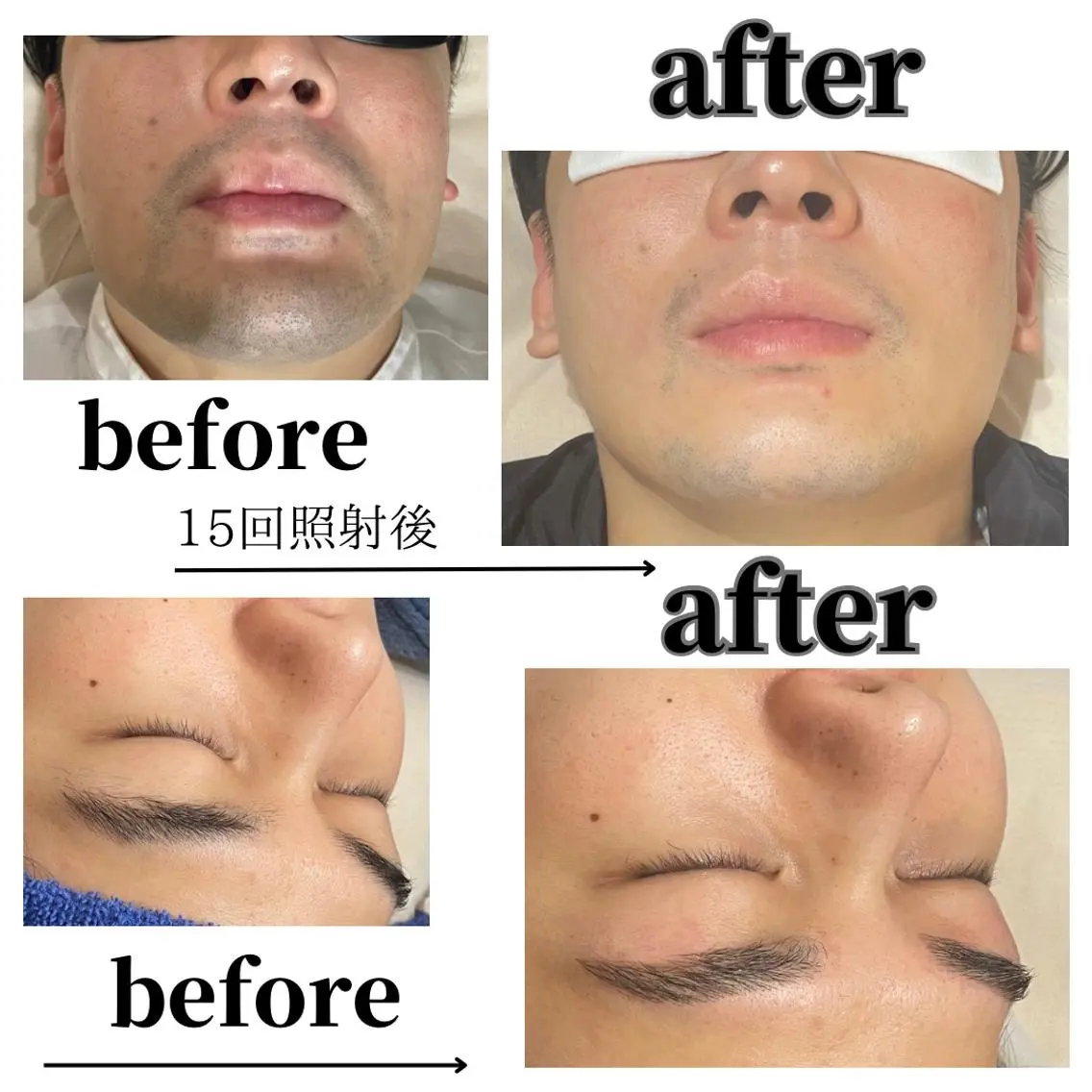●ミニモ限定【全顔メンズ脱毛+眉ワックス脱毛】◎¥4700の写真