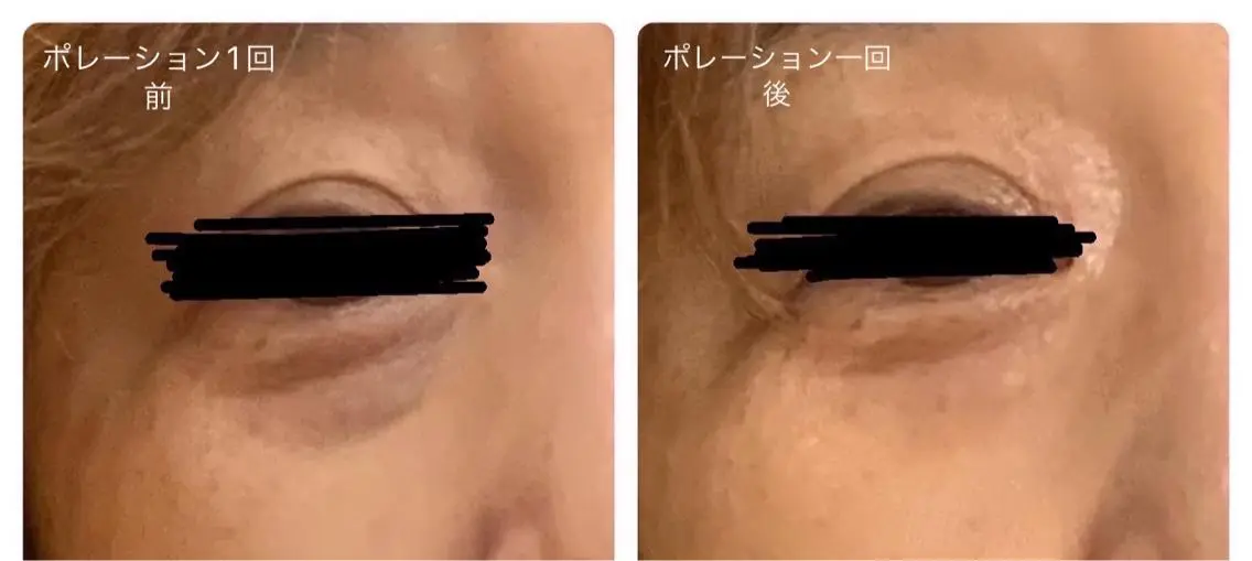 ピュアコラーゲン&ヒアルロン酸導入ポレーション&EMS👶✨✨の写真