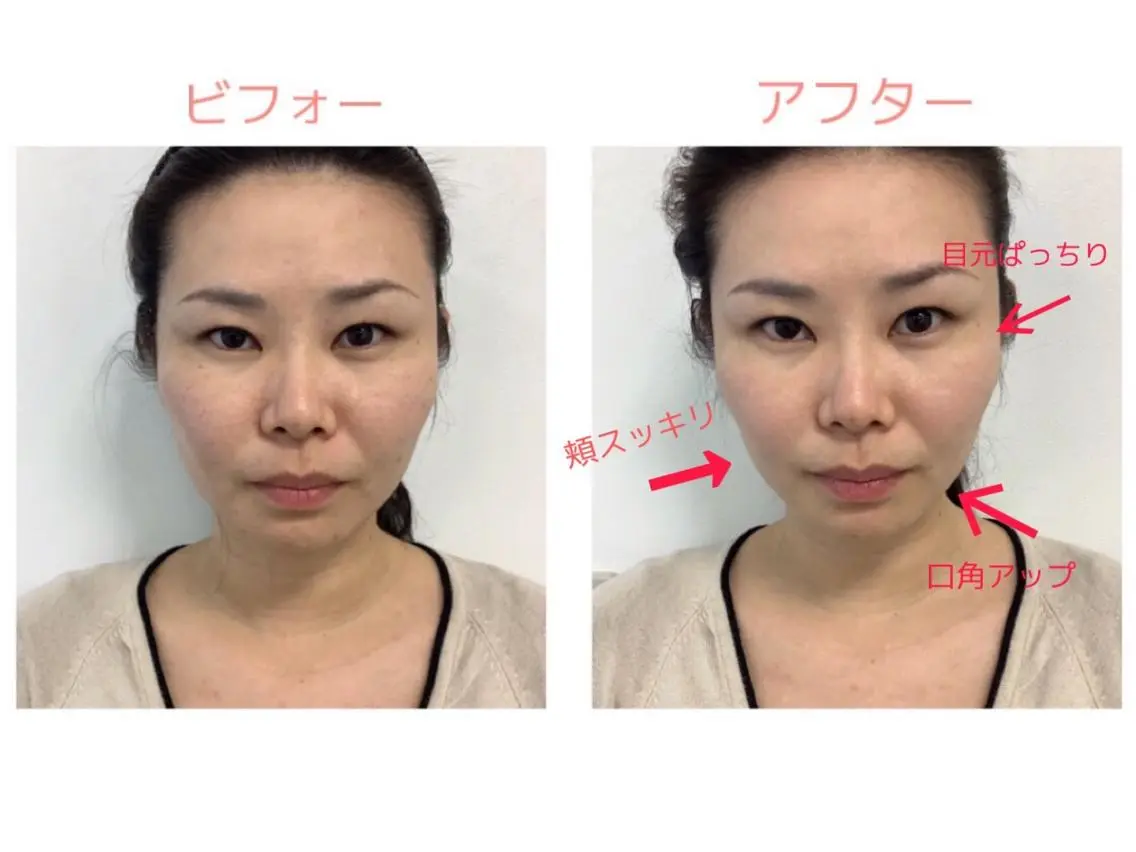 【小顔フェイシャル】高周波美容/全顔、首、肩。鎮静保湿パック付き40分の写真