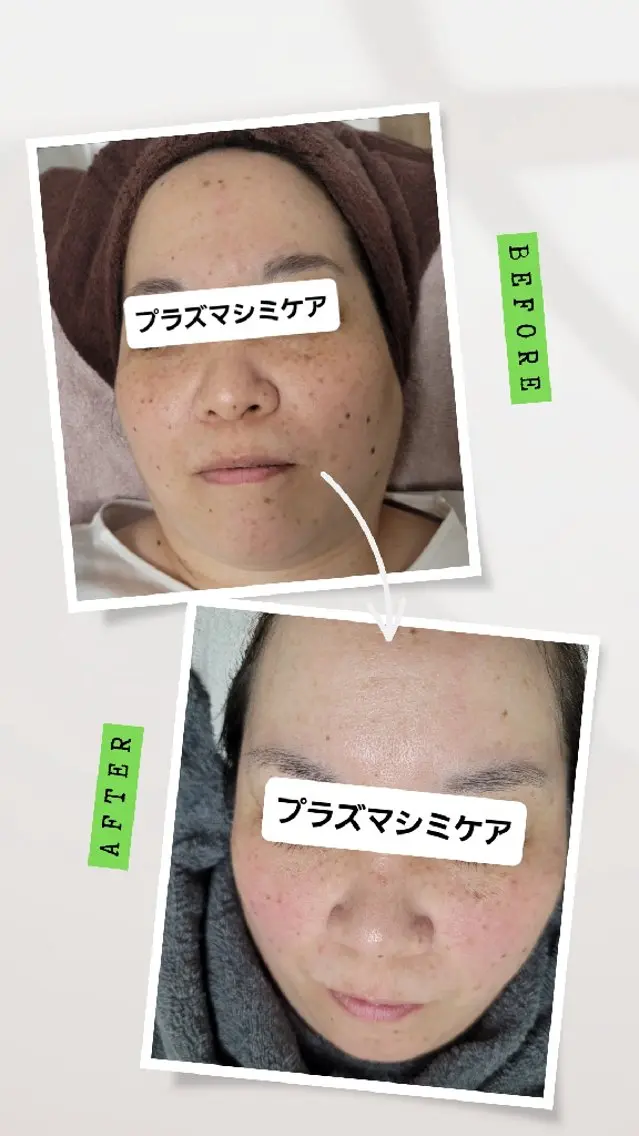 プラズマ+シミケア+水素パック　今あるシミをケアしながらお顔全体をケア。￥9800→￥8000の写真