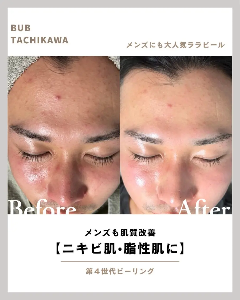【メンズ肌悩みを一掃】ララピール｜皮脂・毛穴・ニキビに対応！初回お試し価格でお気軽に🙌の写真