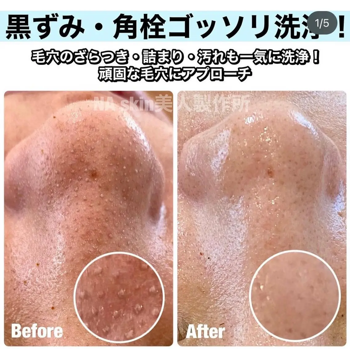 【黒ずみ角栓丸洗い洗浄‼️】ハイドラフェイシャル高濃度水素水のトルネード水流で毛穴を徹底吸引&洗浄＋ハーブピーリング🌿の写真