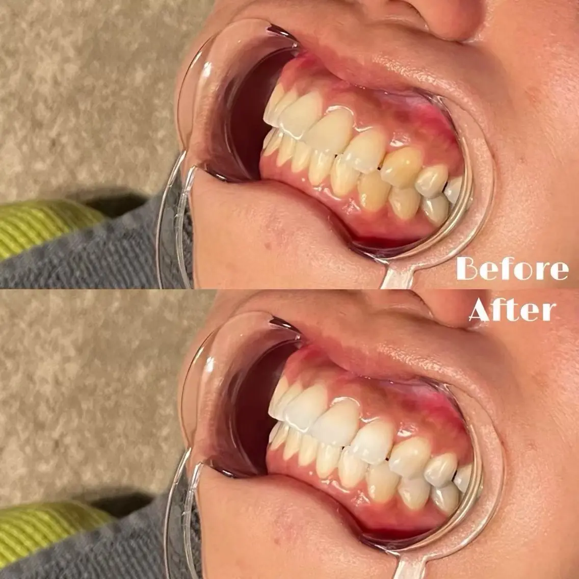 【第一印象UP】 ホワイトニングで理想の白い歯へ🦷✨の写真