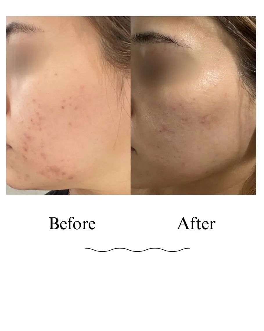 薄皮がめくれてる乾燥肌さん必見!水玉リフティングの写真