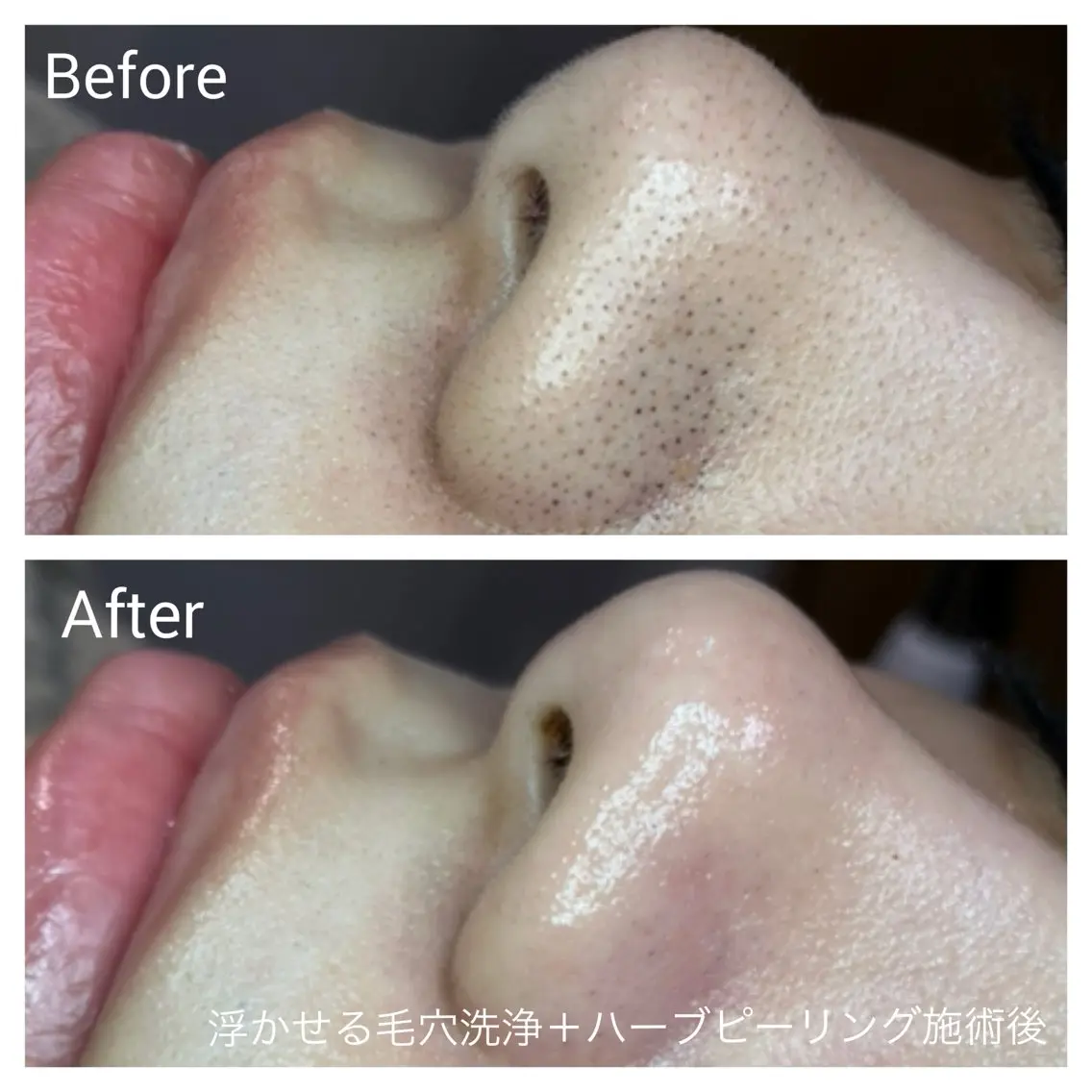 花粉での肌荒れにも🙆‍♀️【シミシワ・ニキビ・毛穴・美白】肌育ハーブピーリングベーシックコース60分🌿の写真