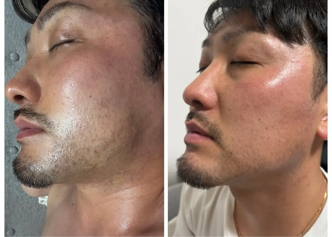 メンズ 脱毛 はるか nanalaオーナーのエステ・リラクイメージ