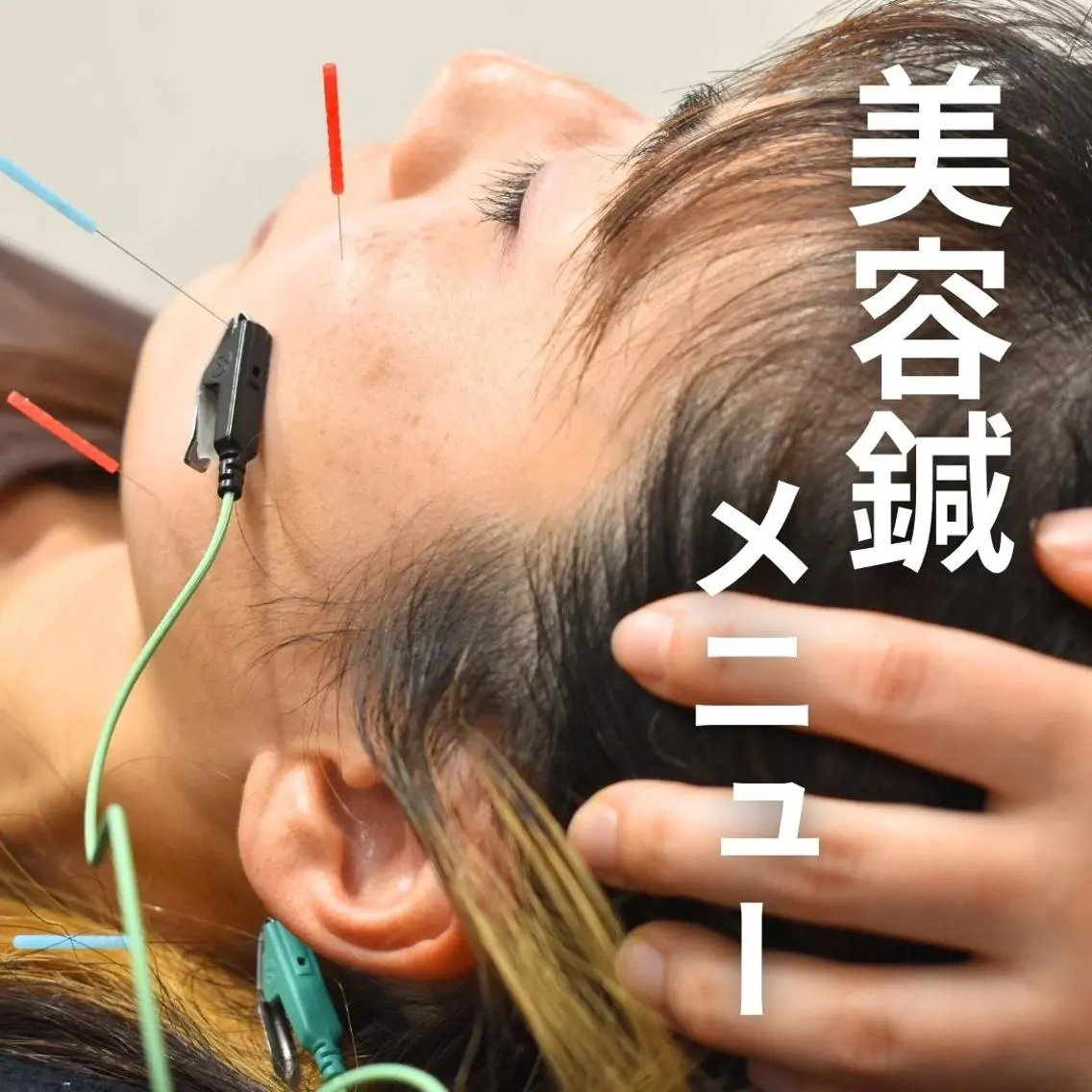 【人気No.1美容鍼】肌質改善・小顔矯正・リフトアップ🌷お顔のお悩みある方におすすめ🌷の写真
