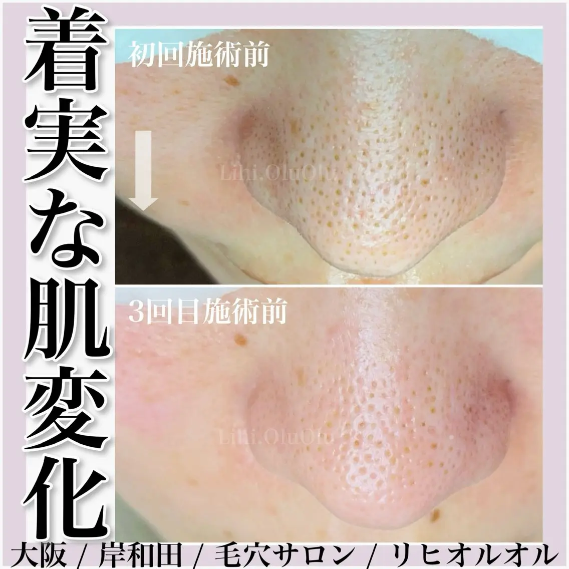 毛穴汚れ改善専門店/ 岸和田/リヒオルオルのエステ・リラクイメージ