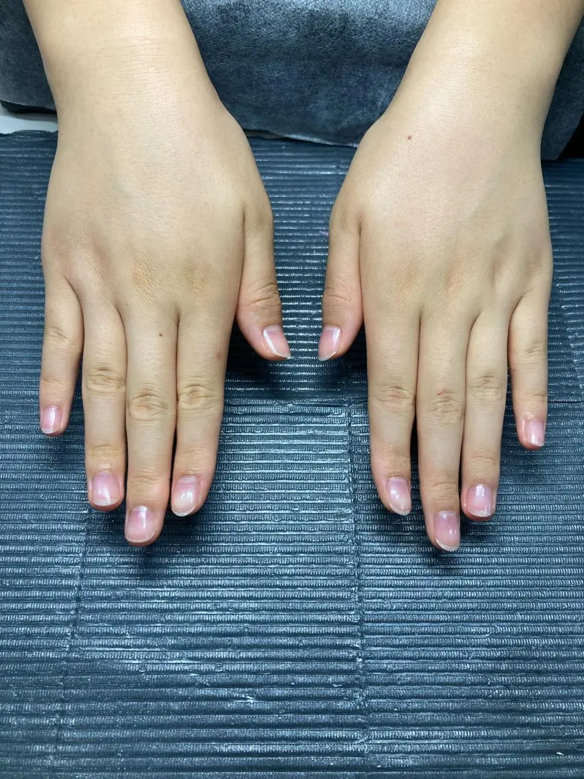 深爪・自爪育成ケアの写真