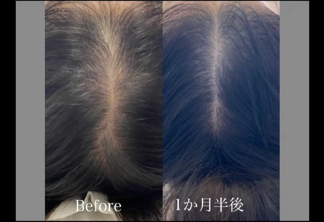 エステで発毛ができる✨効果が早い100％幹細胞培養上清液　ノアグロウスカルプ　メンズ可の写真