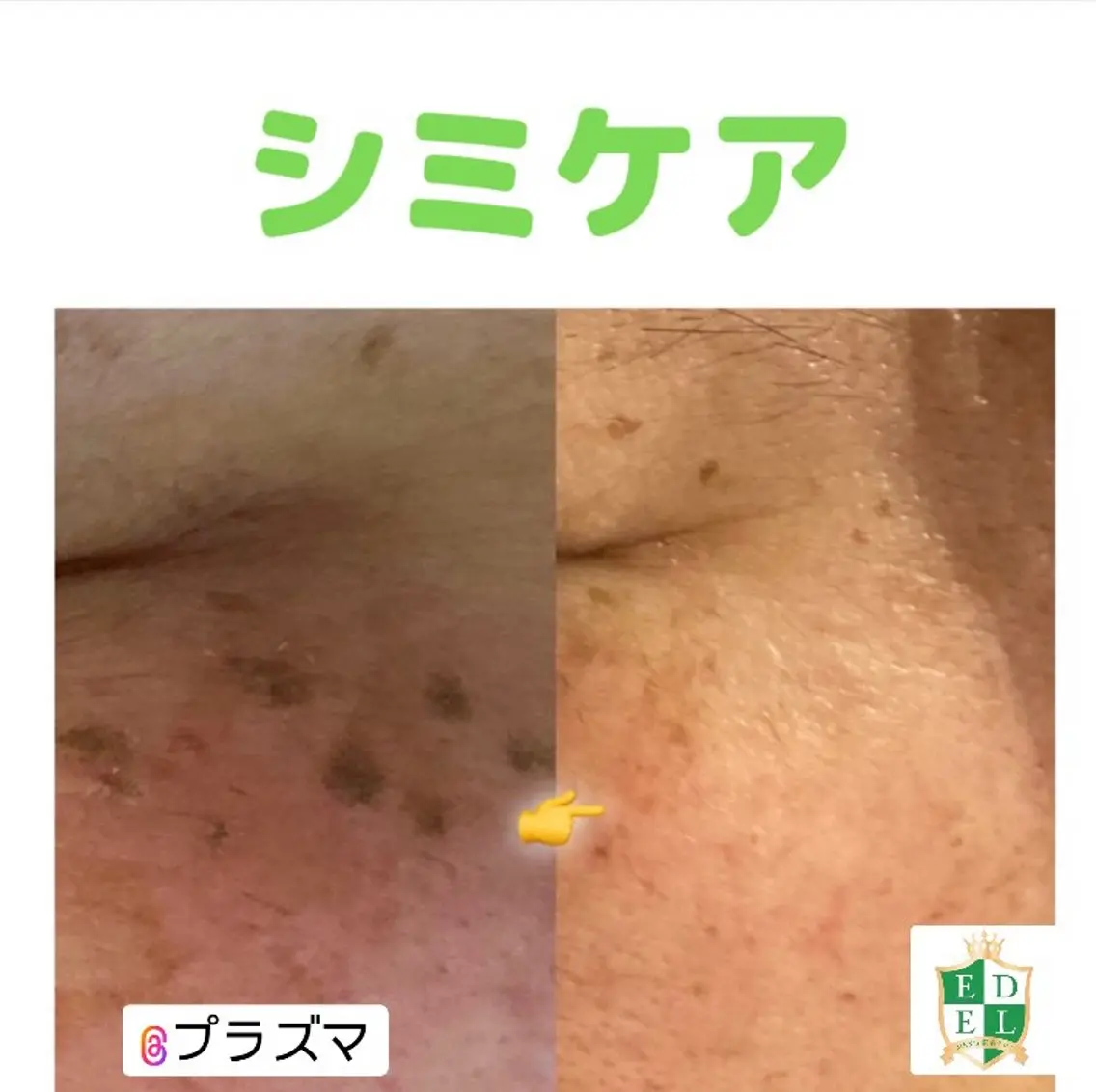 シミケア!!今話題のプラズマでシミを撃退!20分取り放題!の写真
