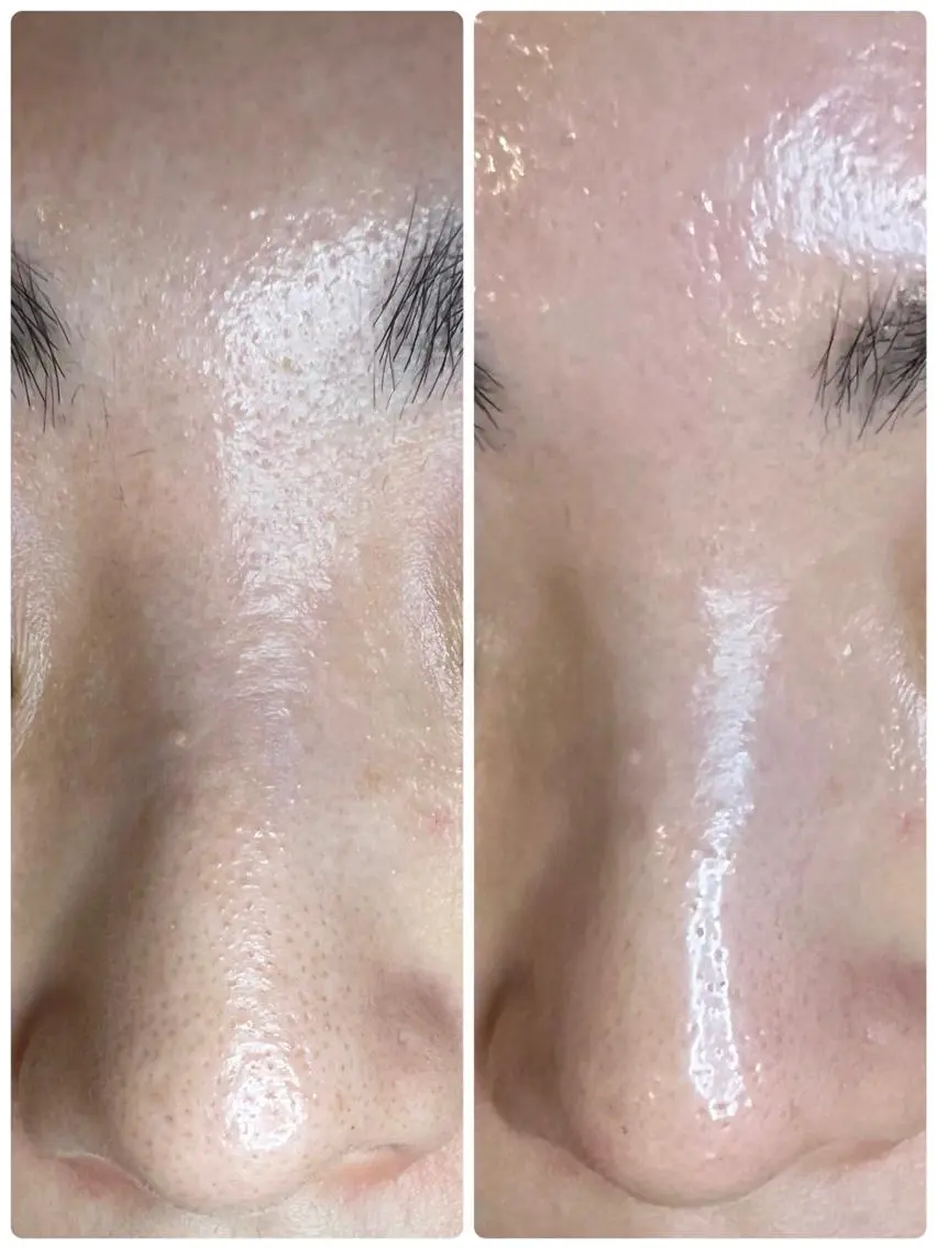 【当日予約限定】毛穴改善コース👃✨長年悩んでいた鼻の黒ずみ、詰まりが一回で改善！？当店1番人気コース♪の写真