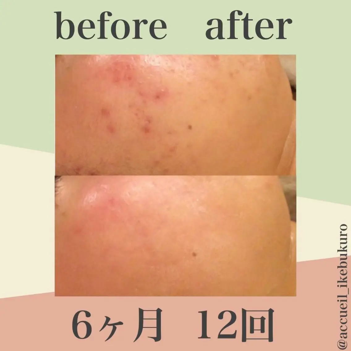 ミディアム カラー パーマ ヘアアレンジ メンズ キッズ ネイル マツエク・マツパ エステ リラク ニキビ・肌質改善専門 ♡人生が変わるサロンのエステ・リラクイメージ