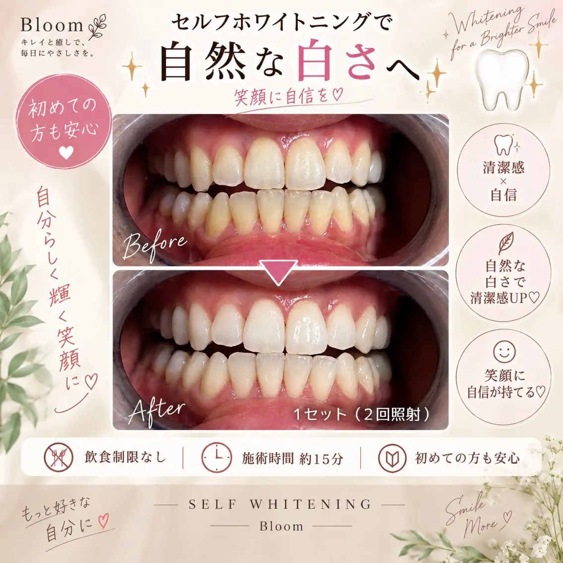 セルフホワイトニング🦷 🕒ご予約枠10:00/12:00/14:00の写真