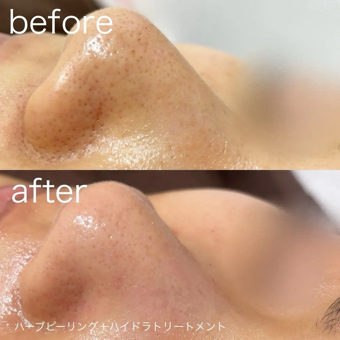 脱毛 lulularico Yuのネイルデザイン