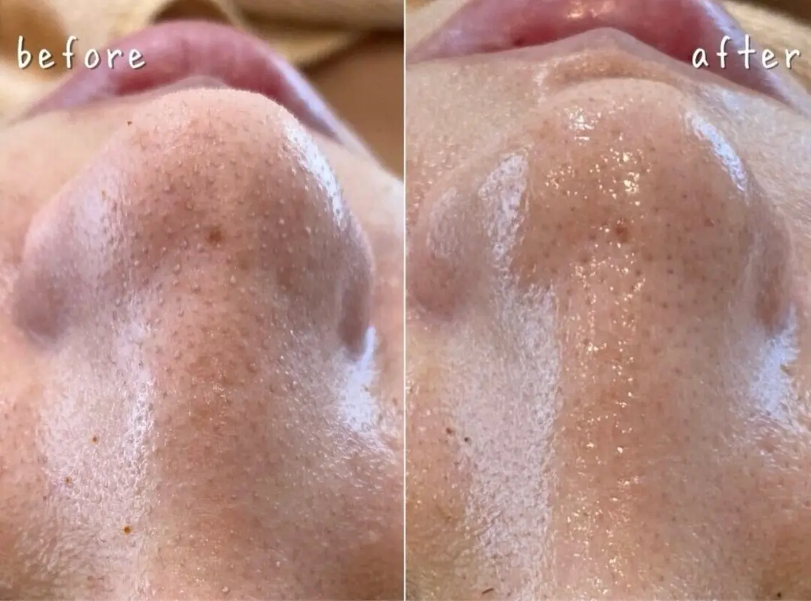 【毛穴詰まりやごわつきが気になる方】毛穴洗浄+ハーブピーリングの写真