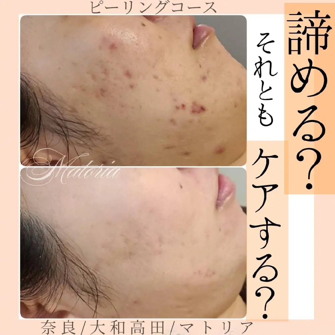 ニキビ肌改善コースの写真