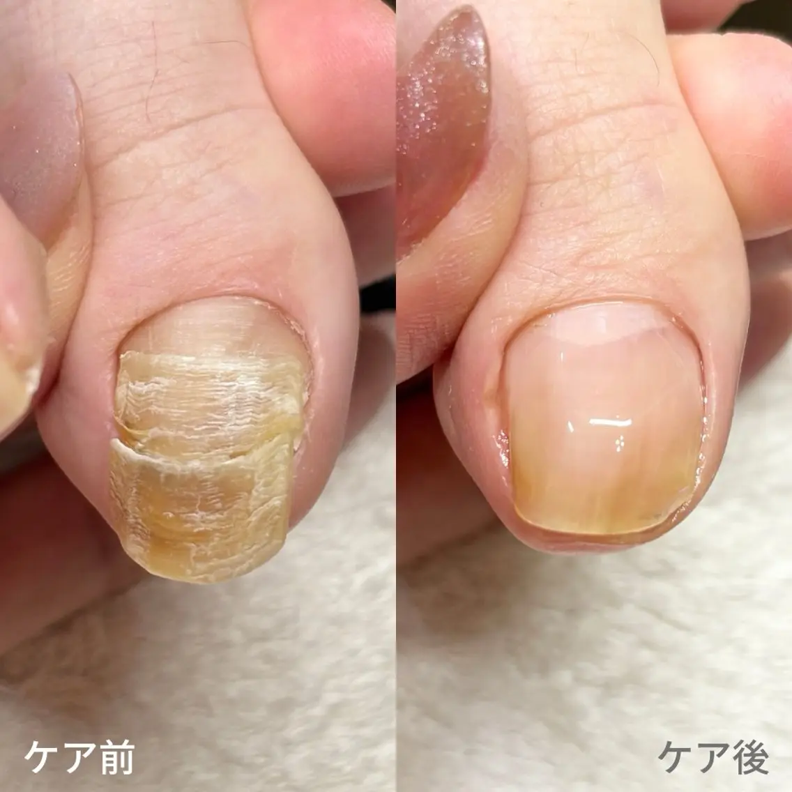 ネイル 巻き爪・肥厚爪ケア 専門サンセリテのネイルデザイン