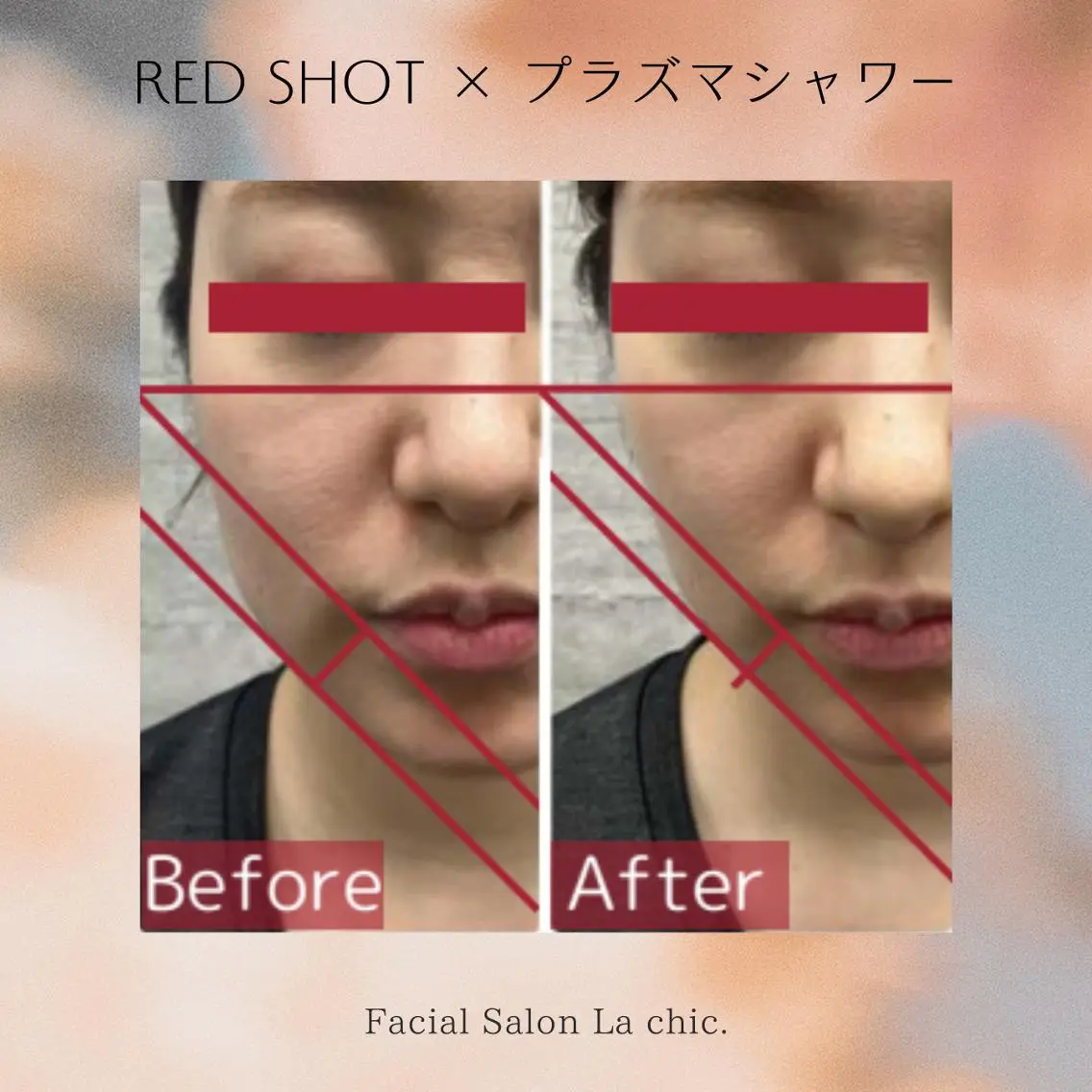 【ご新規限定✨自分史上最高のフェイスラインへ】毛穴洗浄×プラズマシャワー🌿レッドショット導入＋マッサージで理想の輪郭への写真