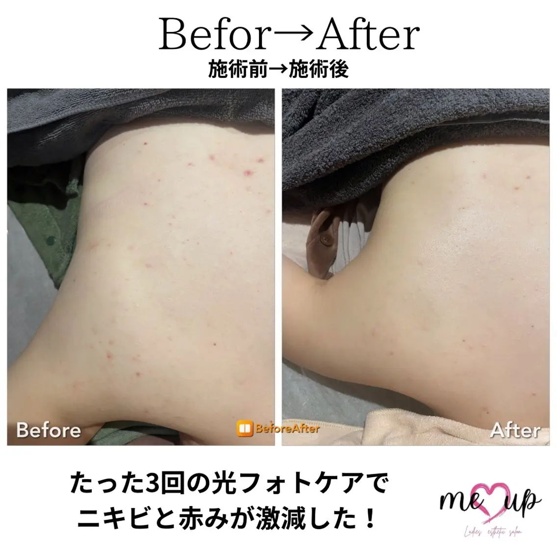 エステ Meupニキビ専門店 背中/ハーブ/肌管理のその他イメージ