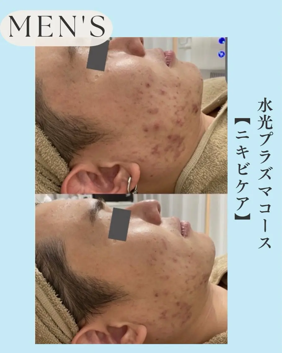 【メンズ】【モニター¥5800/3名限定募集】水光プラズマ ニキビ肌・凸凹跡・肌荒れの写真