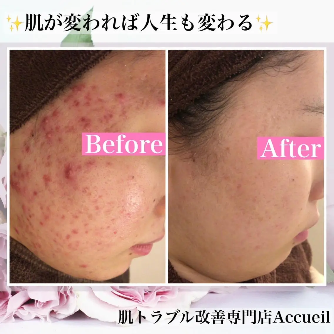 エステ リラク 3か月で肌革命👼 ニキビ専門店💫のエステ・リラクイメージ
