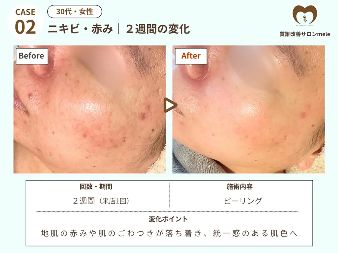 【9月中ご来店限定】🌟大人ニキビケア・毛穴🌟角質除去　¥6,600→¥5,500の写真