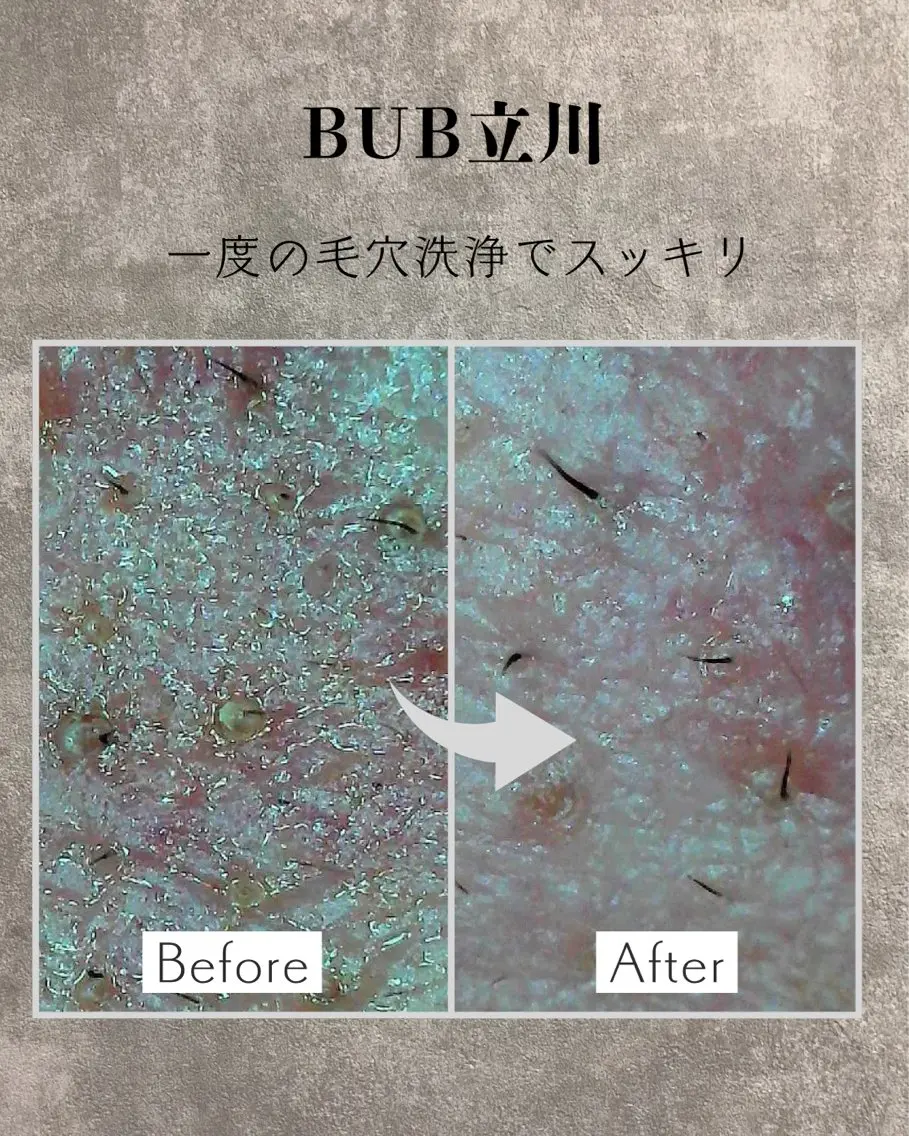 【毛穴の黒ずみ・詰まりを徹底除去】ハイドラ洗浄コース|翌日から毛穴レス肌を実感の写真