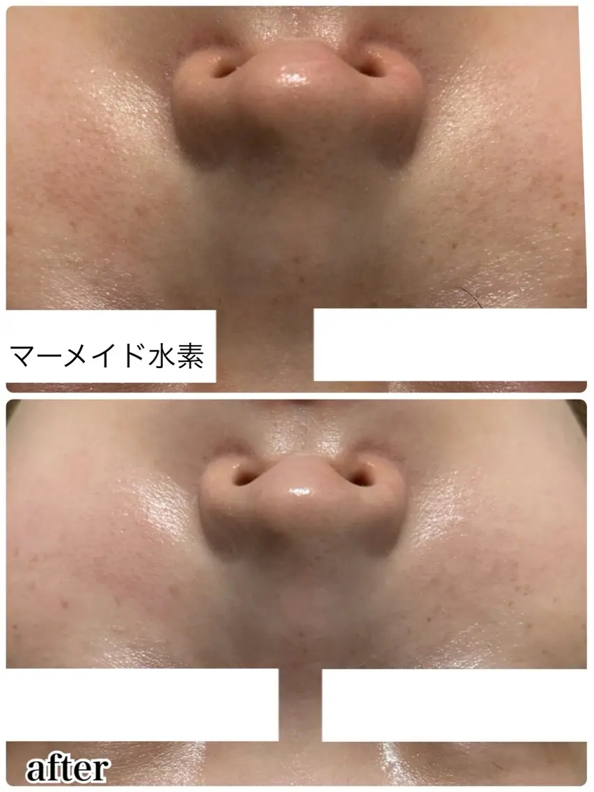 【ハリ・キメ・ツヤ・水光肌✨】マーメイド水素トリートメント🧜♀️🫧の写真